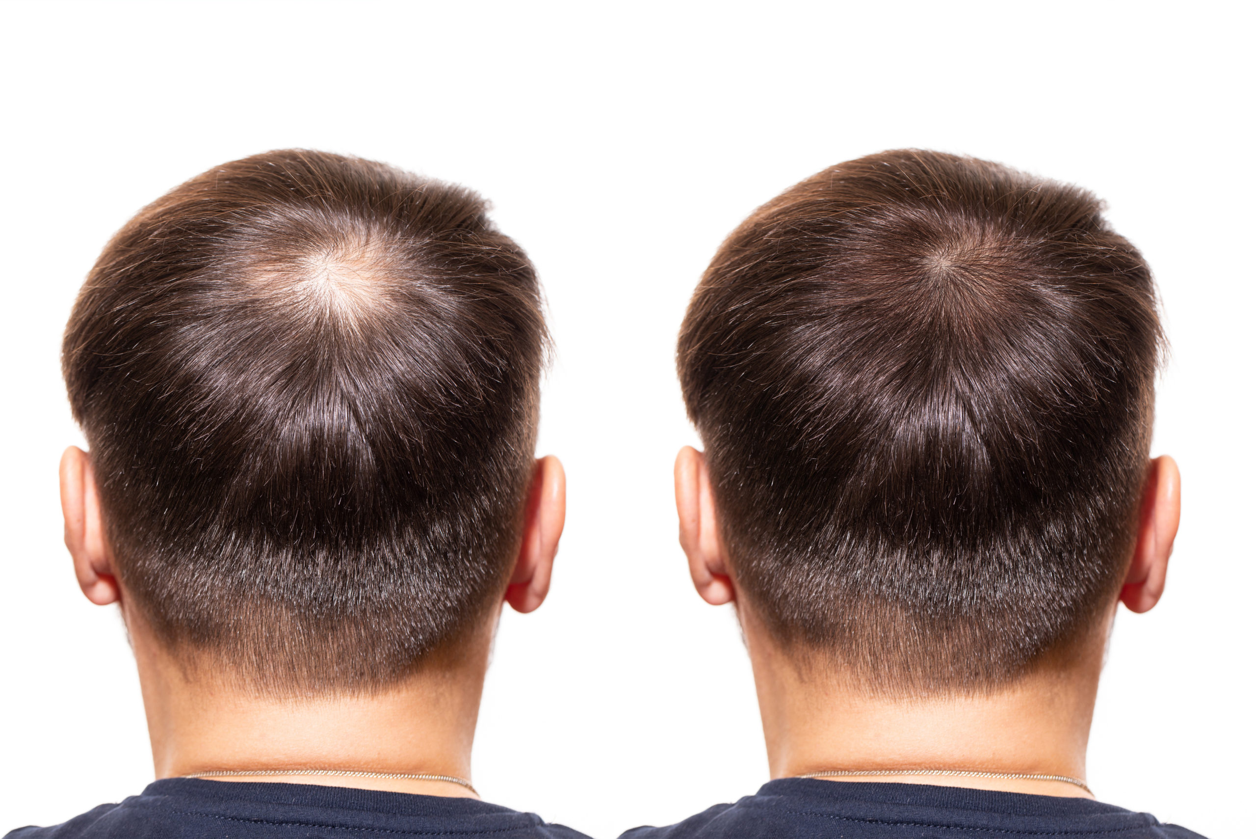Hair Restoration Treatment Lexington, KY | Anti-Aging Institute