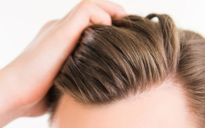 HOW TO STOP A RECEDING HAIRLINE: TREATMENT OPTIONS